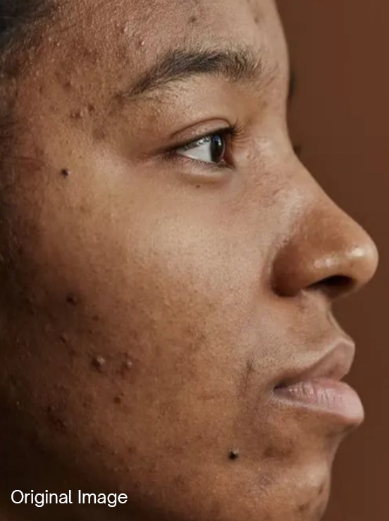 Skin correction — after
